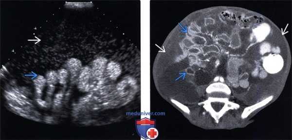 Методы обследования асцита