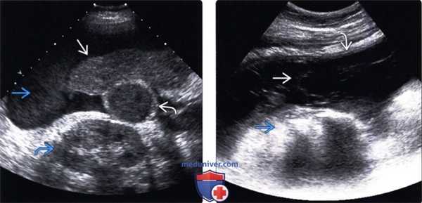 Методы обследования асцита