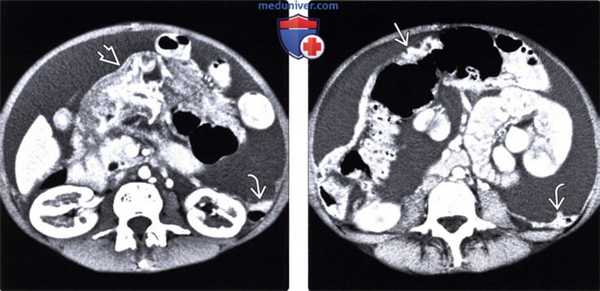 Рентгенограмма, КТ, МРТ, УЗИ при асците