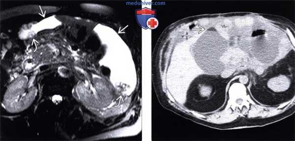 Рентгенограмма, КТ, МРТ, УЗИ при асците