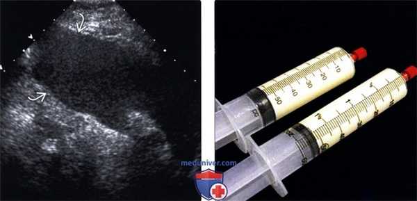 Методы обследования асцита
