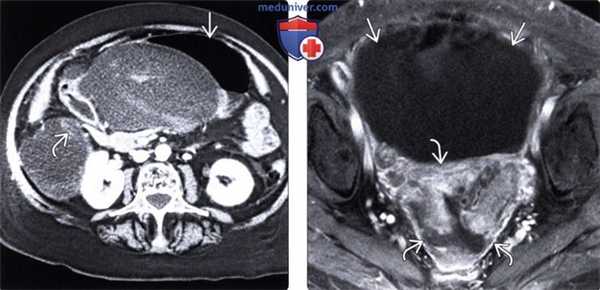 Рентгенограмма, КТ, МРТ, УЗИ при асците