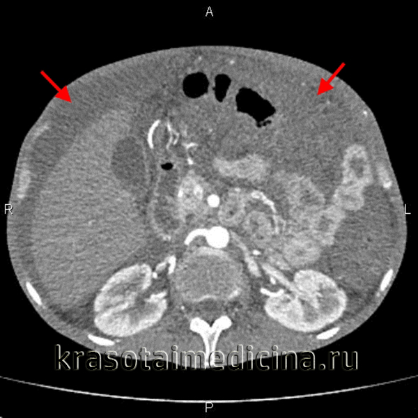 КТ живота С+. Большое количество жидкости в брюшной полости (асцит)