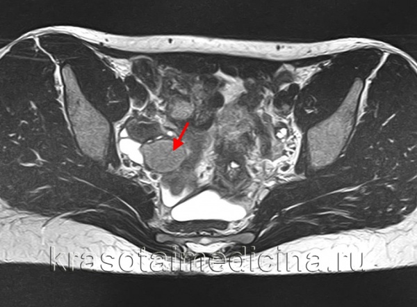 Эндометриоидная киста яичника