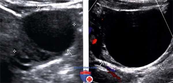 Методы обследования функциональной кисты яичника