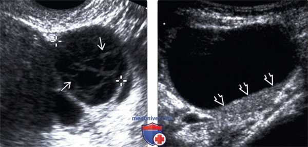 Методы обследования функциональной кисты яичника