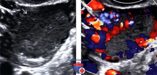 Методы обследования функциональной кисты яичника