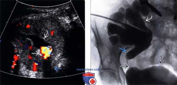 Методы обследования гидронефроза пересаженной почки