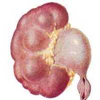 Гидронефроз