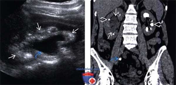 УЗИ при гидронефрозе