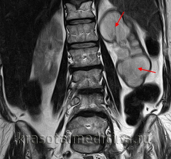 МРТ ОБП. Выраженное расширение лоханки и чашечек левой почки с атрофическими изменениями ее паренхимы.