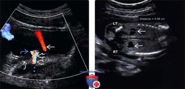 УЗИ при гидронефрозе