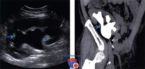 Методы обследования гидронефроза пересаженной почки