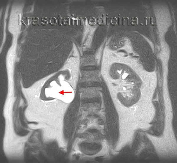 МРТ ОБП и забрюшинного пространства. Выраженное расширение чашечек и лоханки правой почки на фоне истончения ее паренхимы
