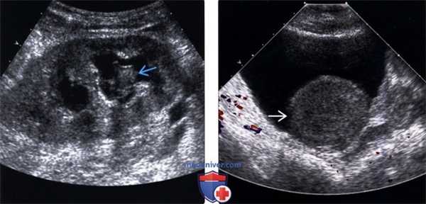 Методы обследования гидронефроза пересаженной почки