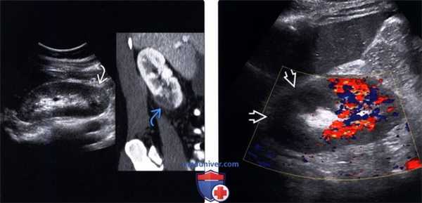 УЗИ, КТ при инфаркте почки