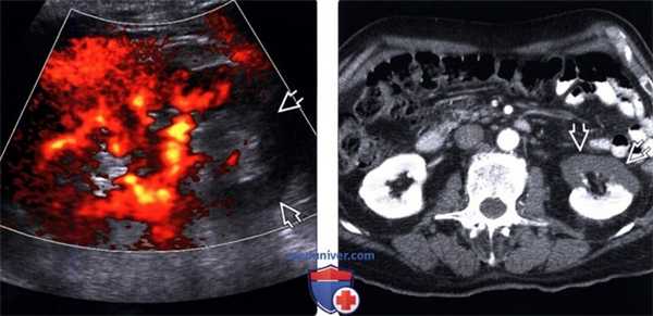 УЗИ, КТ при инфаркте почки