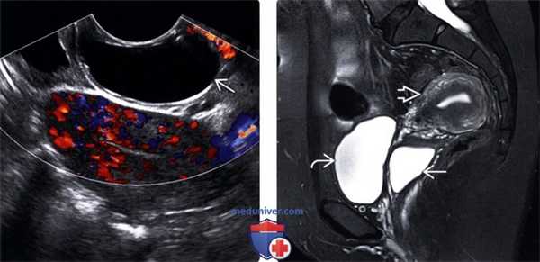 Методы обследования кисты гартнерова хода