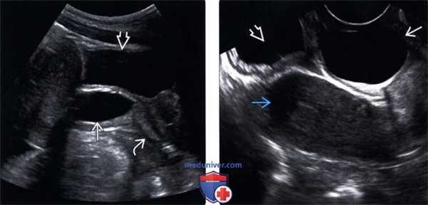 Методы обследования кисты гартнерова хода