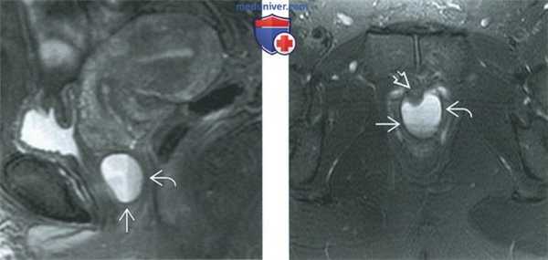 КТ, МРТ, УЗИ при кисте гартнерова канала