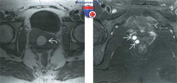 КТ, МРТ, УЗИ при кисте гартнерова канала