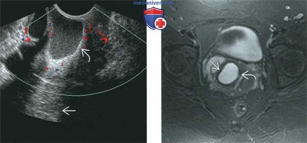КТ, МРТ, УЗИ при кисте гартнерова канала