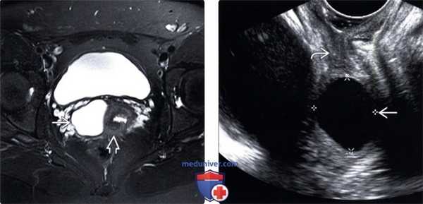 Методы обследования кисты гартнерова хода