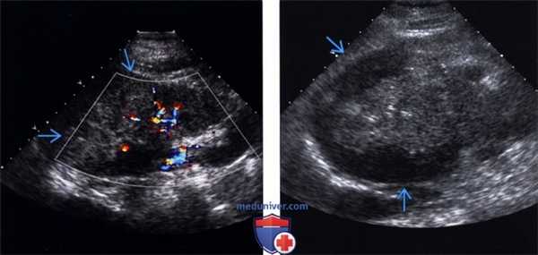 УЗИ при метастазах в почки