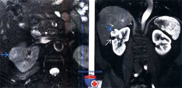 КТ, МРТ, УЗИ при метастазах в почки