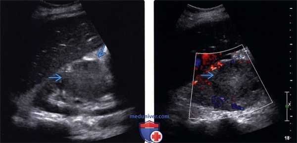 УЗИ при метастазах в почки