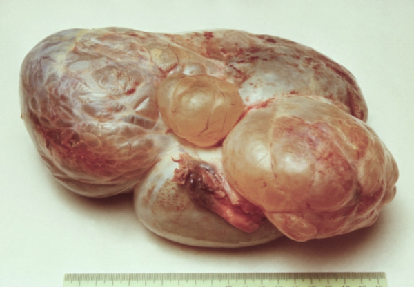 Метастатический рак яичников