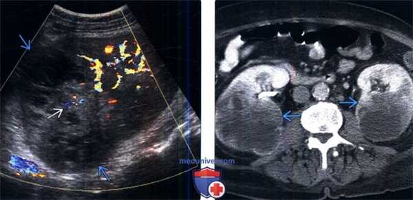 КТ, МРТ, УЗИ при метастазах в почки