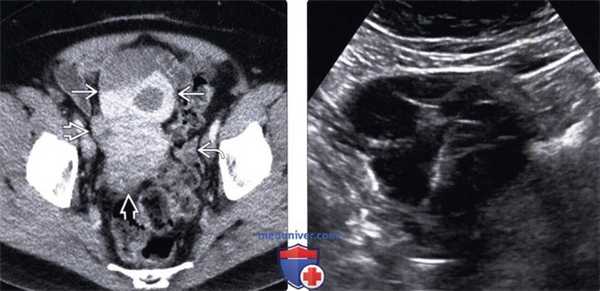 Методы обследования метастазов в яичники и опухоли Крукенберга