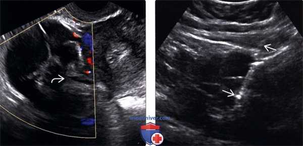 Методы обследования метастазов в яичники и опухоли Крукенберга