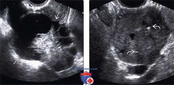 Методы обследования метастазов в яичники и опухоли Крукенберга