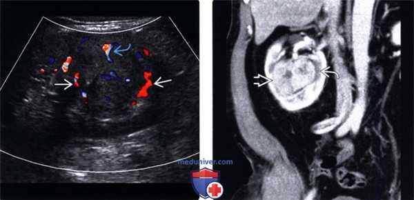 УЗИ, КТ при почечноклеточном раке почки