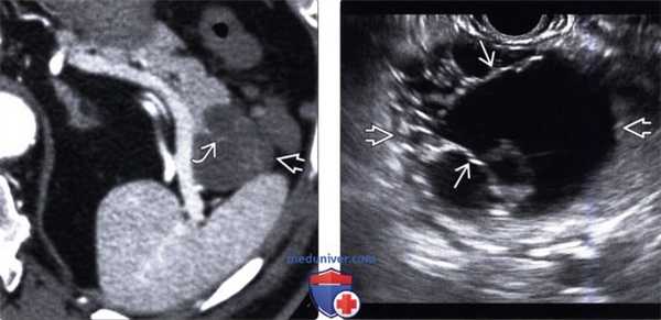 УЗИ, КТ при муцинозной кистозной опухоли поджелудочной железы