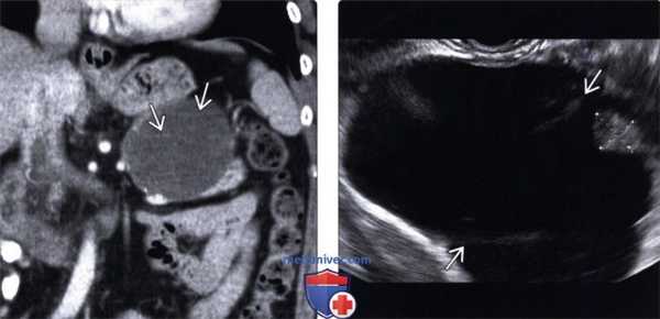 УЗИ, КТ при муцинозной кистозной опухоли поджелудочной железы