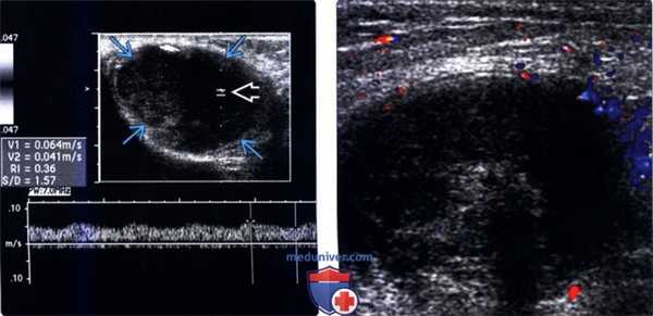 УЗИ при неопущении яичка