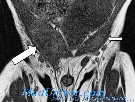 неопущение яичка у детей