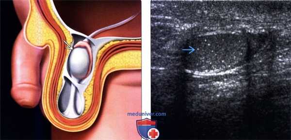 УЗИ при неопущении яичка