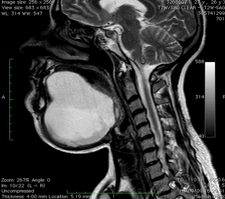 МРТ мягких тканей шеи, что показывает