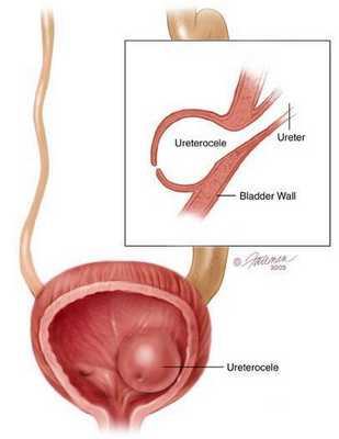Уретероцеле