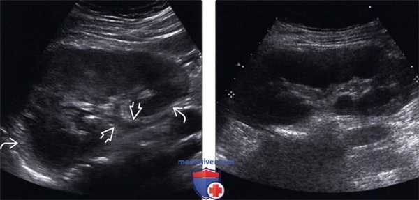 УЗИ при остром пиелонефрите