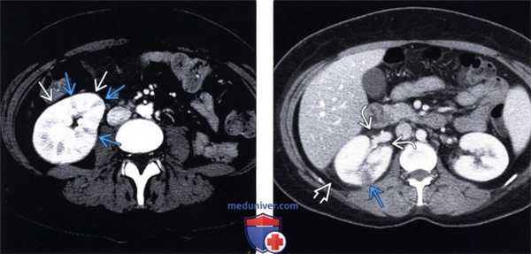 УЗИ при остром пиелонефрите