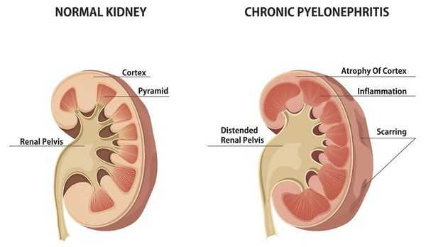 Хроническое воспаление почек