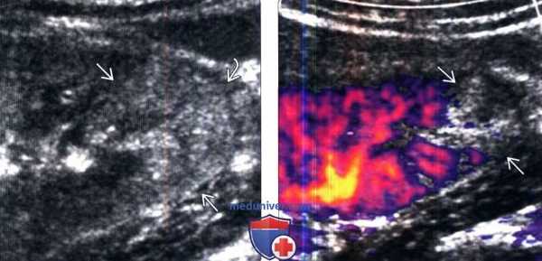 КТ, МРТ при остром пиелонефрите