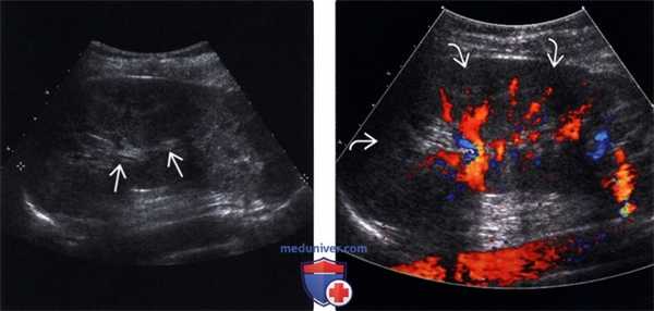 УЗИ при остром пиелонефрите