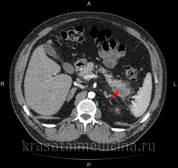 Панкреатит