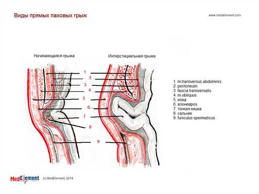 Прямые паховые грыжи